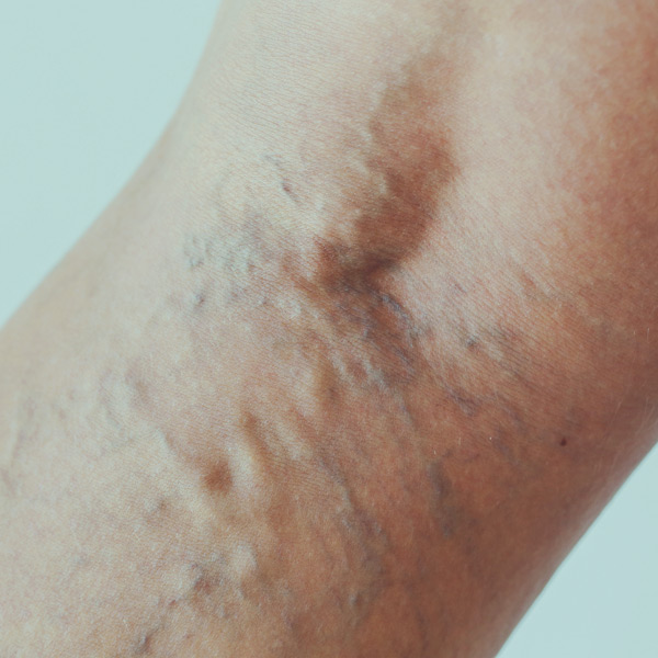 Varicose-Veins-web