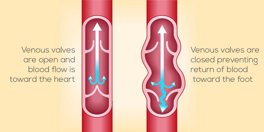 vein-illistration