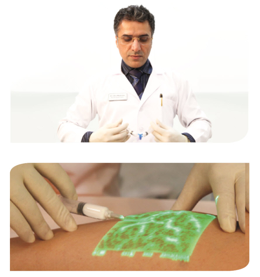 Foam Injection Sclerotherapy